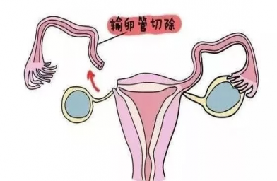 北京慈铭博鳌国际医院三代试管婴儿，切除双侧输卵管还能做试管婴儿吗？
